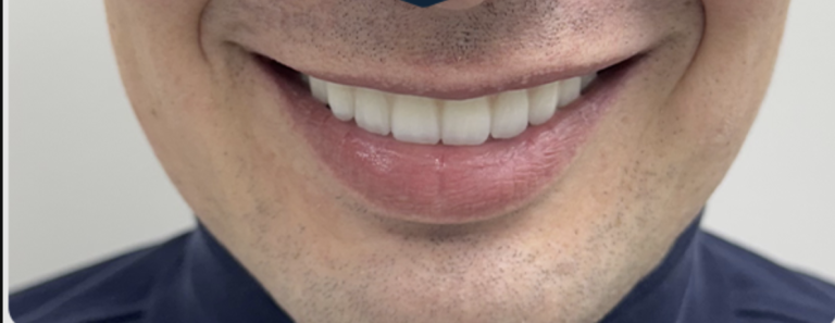 Smile Transformation - After