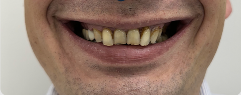 Smile Transformation - Before