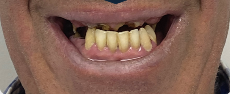 Smile Transformation - Before