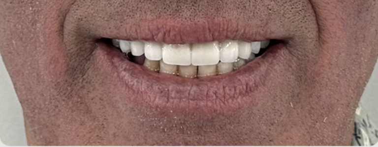 Smile Transformation - After