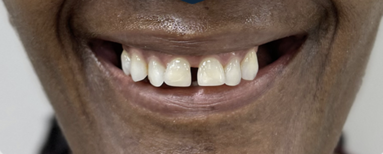 Smile Transformation - Before