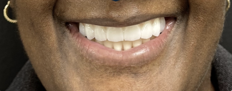 Smile Transformation - After
