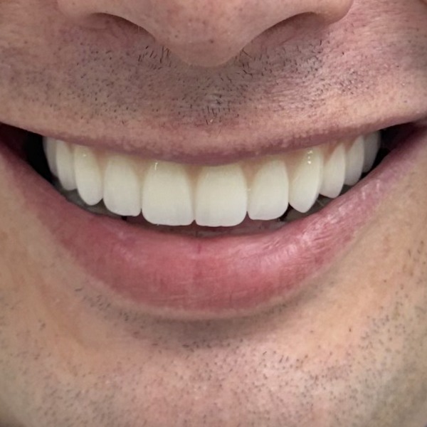 Smile after dental implants