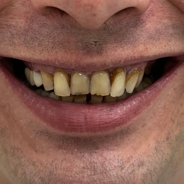 Smile before dental implants