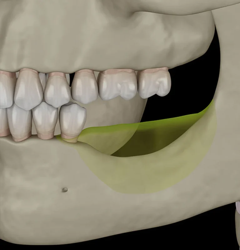 Bone Loss in Your Jaw