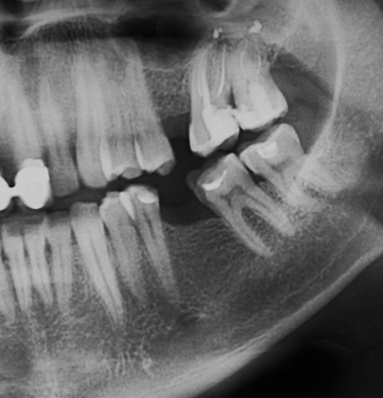 Loose or Missing Teeth