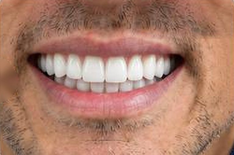 Smile Transformation - After