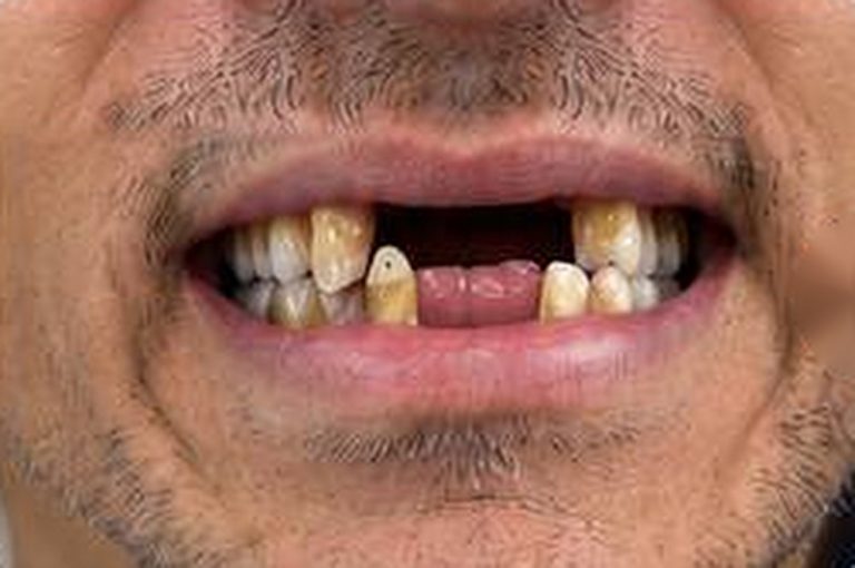 Smile Transformation - Before